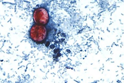 Cyclospora outbreak to be declared over