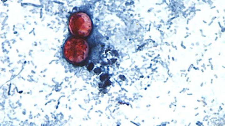 Cyclospora outbreak to be declared over