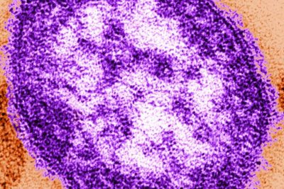Adult woman dies of measles complications in growing Pennsylvania outbreak