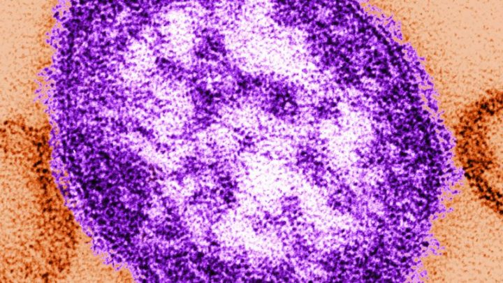 Adult woman dies of measles complications in growing Pennsylvania outbreak